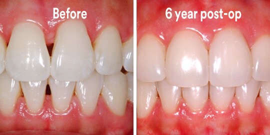 black triangle restoration teeth before and after
