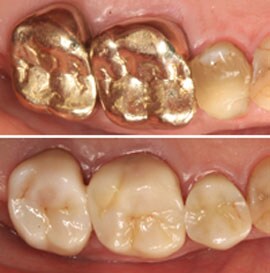 Lava™ Plus High Translucency Zirconia Predictable Color Match-An A2 is an A2