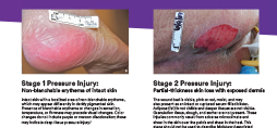Pressure Injury Staging card