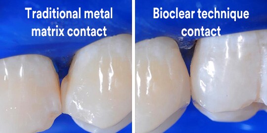 posterior restoration teeth before and after
