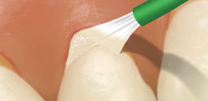 Vanish™ 5% Sodium Fluoride White Varnish and Vanish™ XT Extended Contact Varnish
